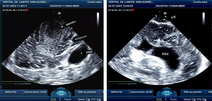 左圖顯示術(shù)中超聲見(jiàn)囊實(shí)性病變，大小約為4x4x3cm，病灶周?chē)X組織水腫明顯；右圖為病灶切除后，術(shù)中超聲示術(shù)腔無(wú)病變殘留