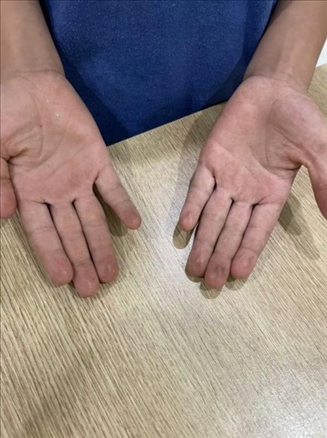 9歲小學(xué)生長(zhǎng)期拍煙卡，手部粗糙長(zhǎng)繭。受訪者供圖