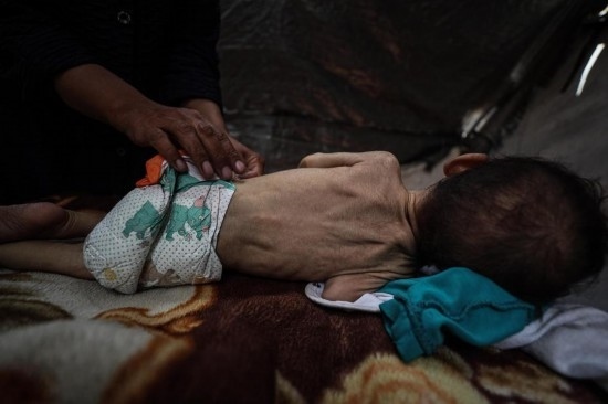 這是5月28日在加沙城西部一處臨時(shí)安置點(diǎn)拍攝的一名營(yíng)養(yǎng)不良的嬰兒。新華社發(fā)（馬哈茂德·扎基攝）